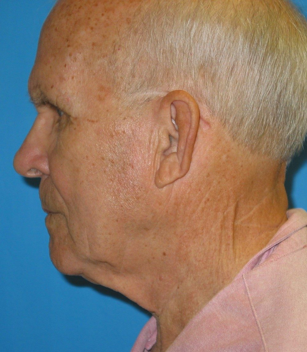 Prendiville Signature Lift before