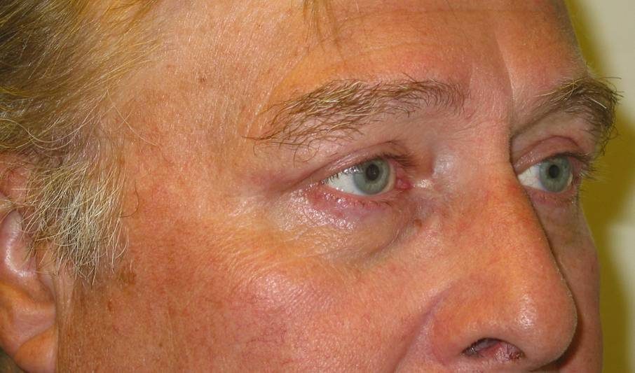 Endoscopic Brow Lift after