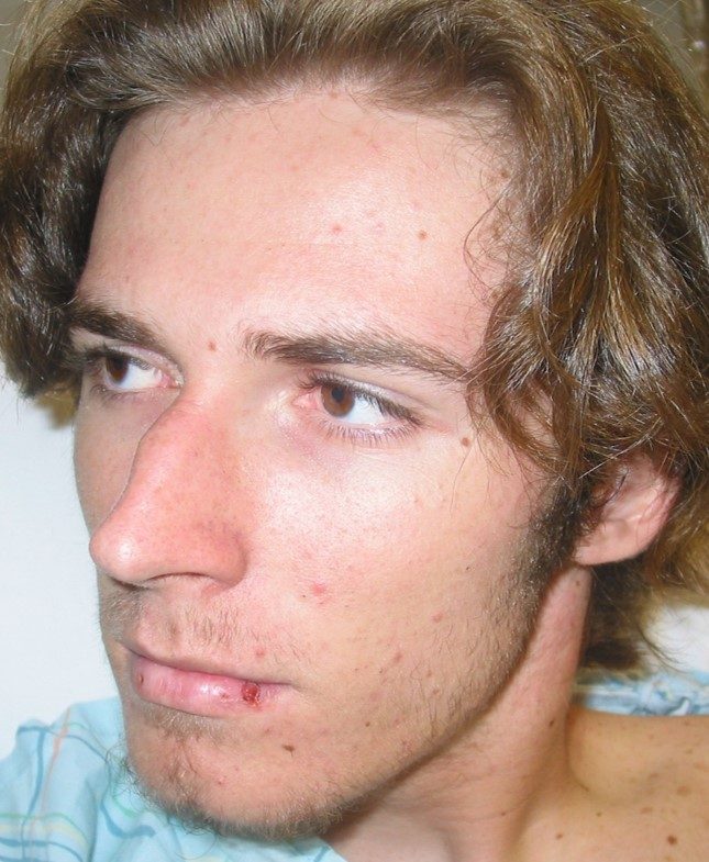 Rhinoplasty before