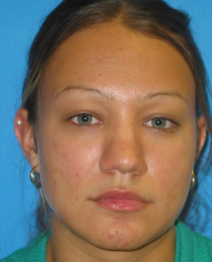 Rhinoplasty before