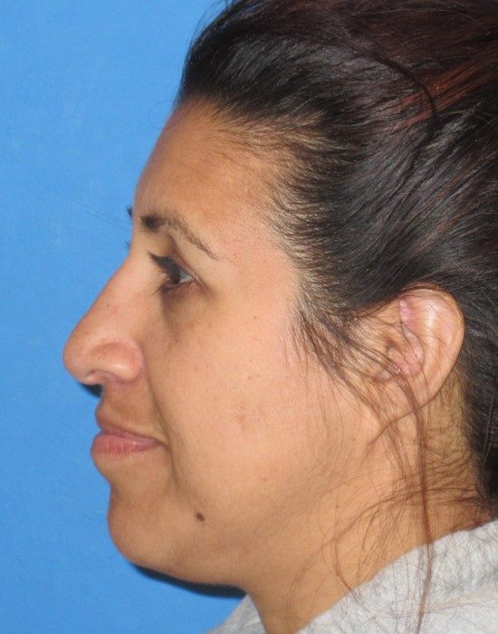 Rhinoplasty before