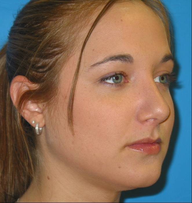 Rhinoplasty after