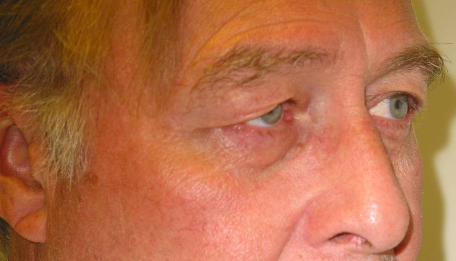 Endoscopic Brow Lift before