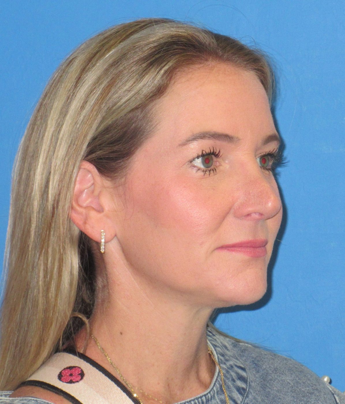 Rhinoplasty after