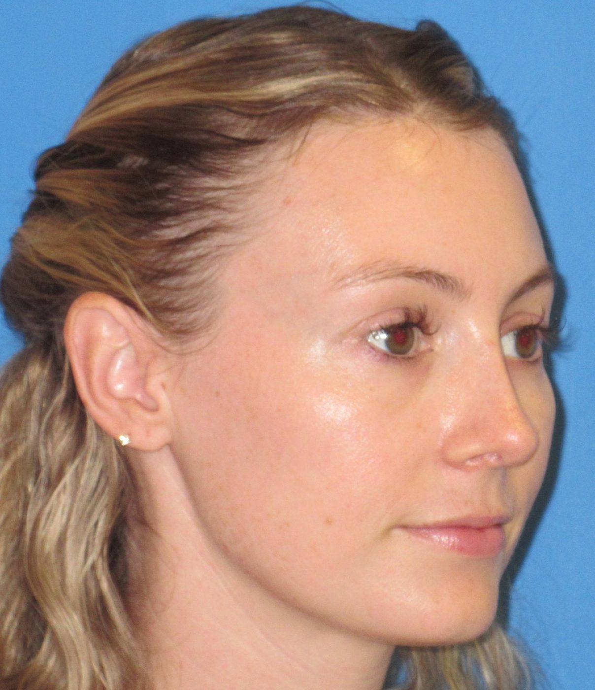 Rhinoplasty after