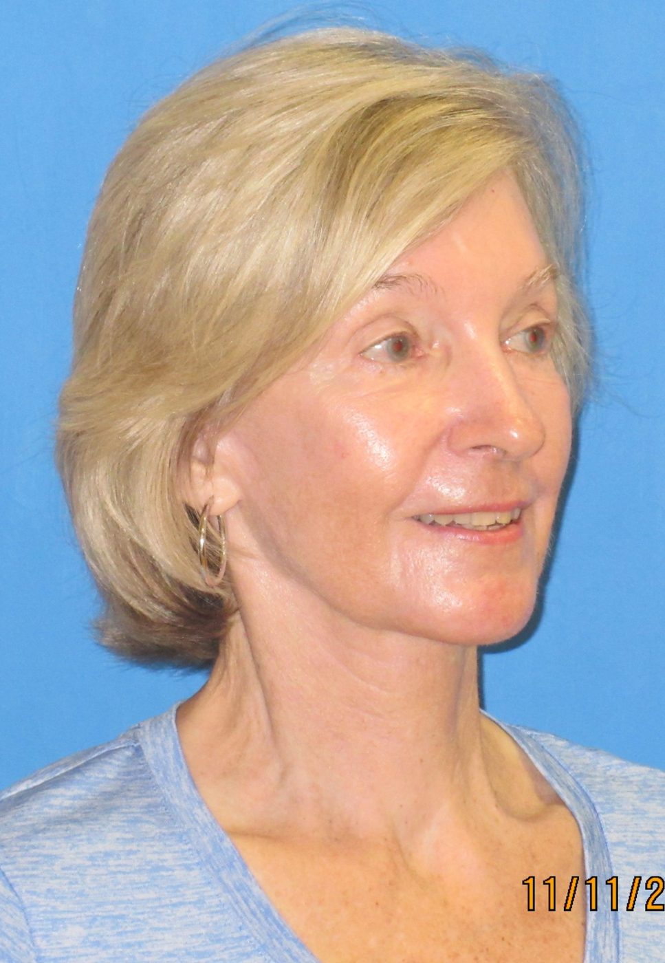 Reconstructive & Laser Therapy after