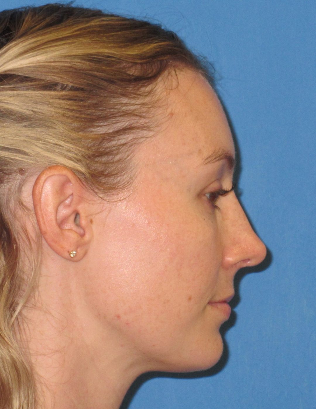Rhinoplasty after