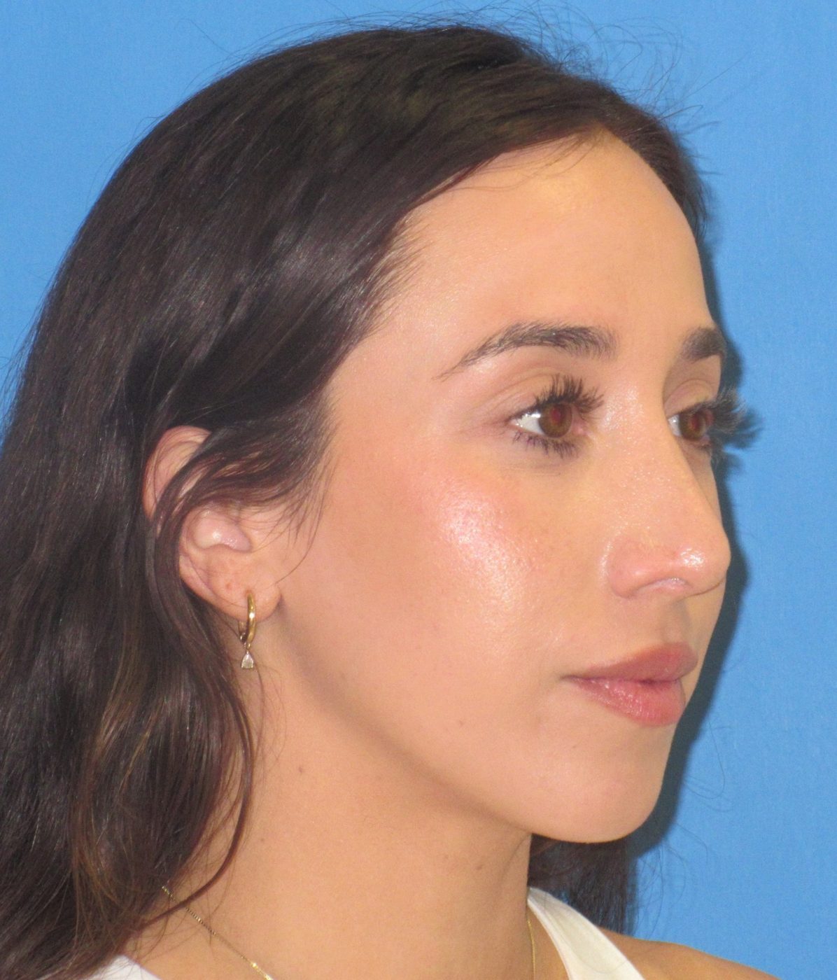 Rhinoplasty after