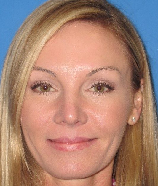 Rhinoplasty after