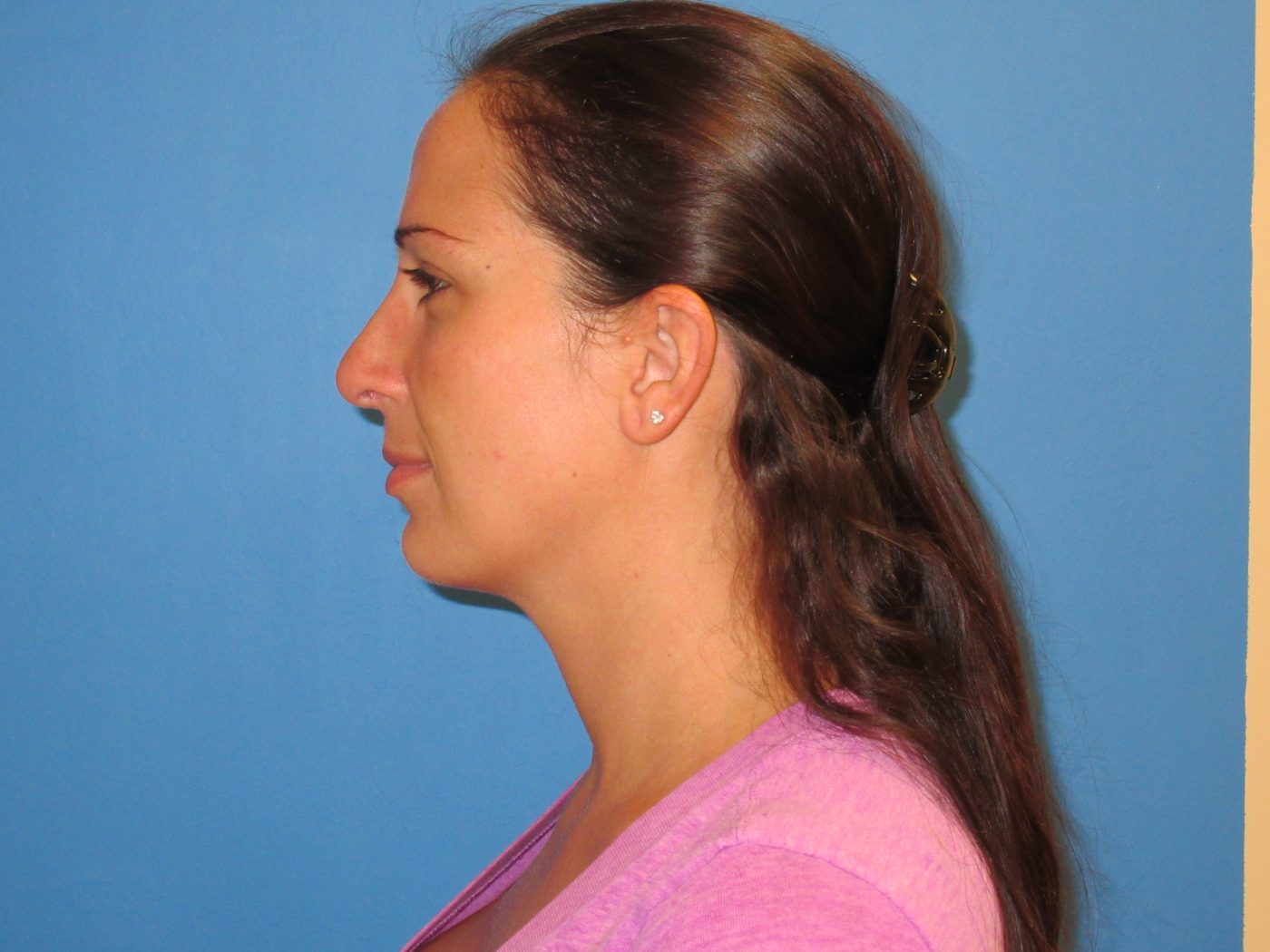 Rhinoplasty after
