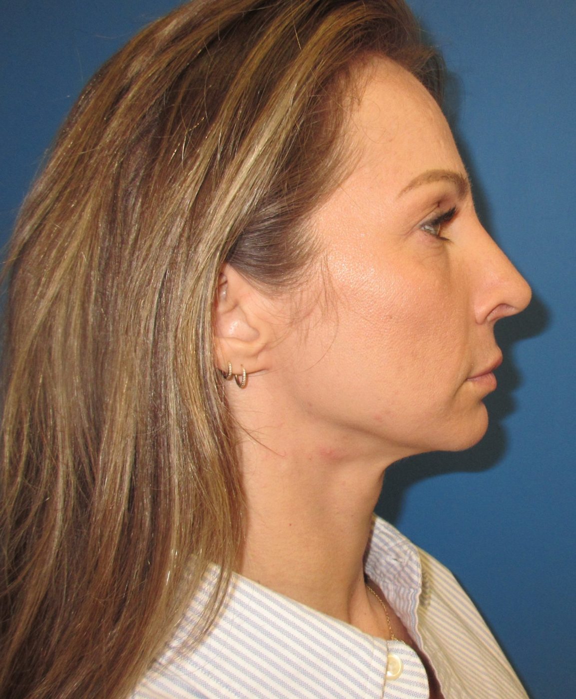 Rhinoplasty after