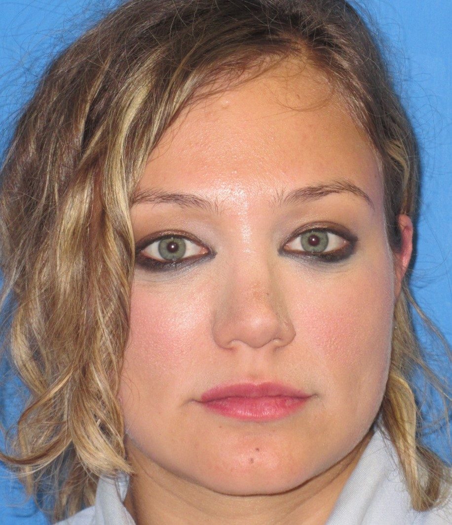 Rhinoplasty after