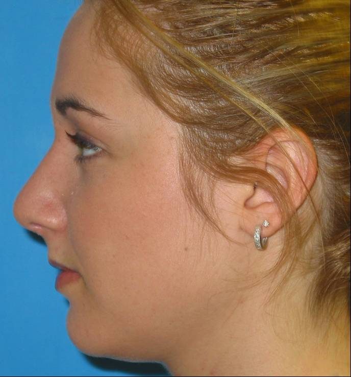 Rhinoplasty after