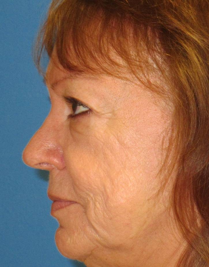 Rhinoplasty after
