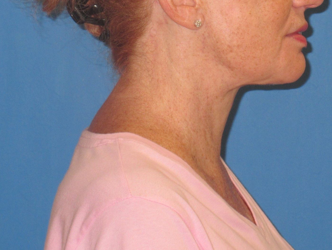 Deep Neck Contouring after