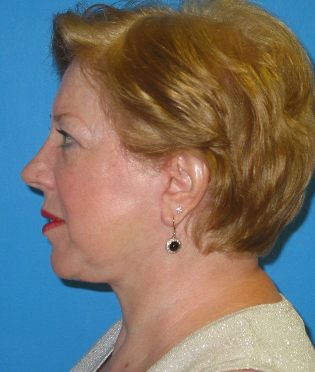 Prendiville Signature Lift after