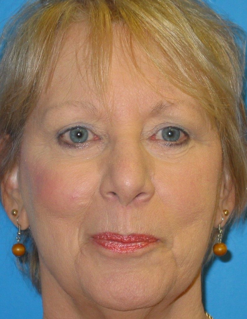 Eyelid Lift after