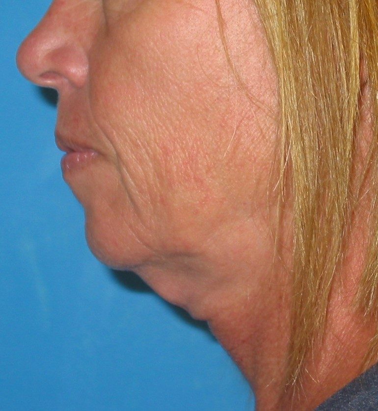 Deep Neck Contouring before