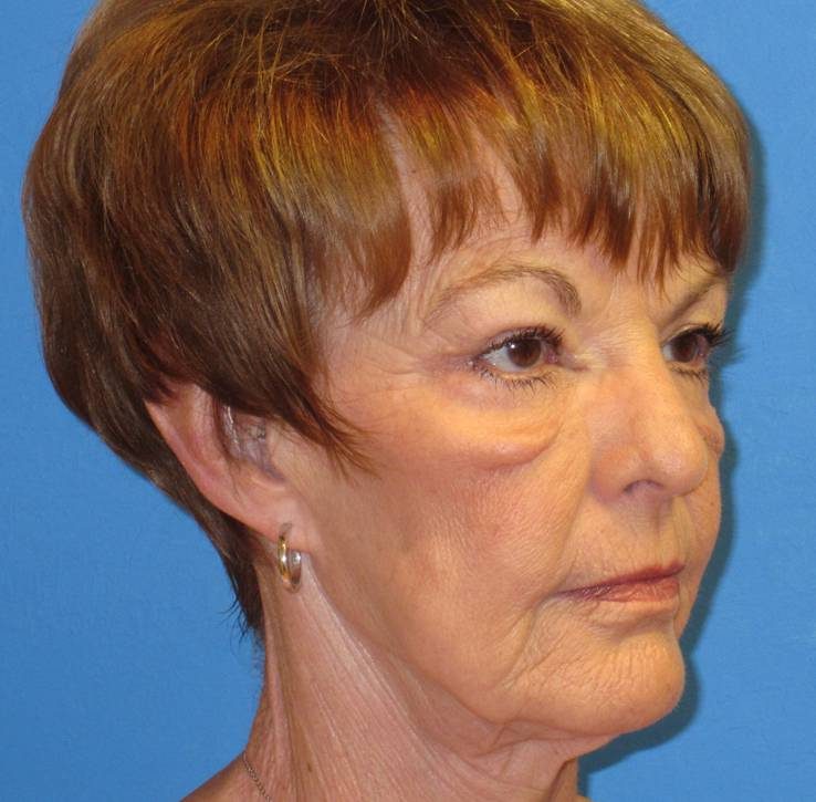 Endoscopic Brow Lift before