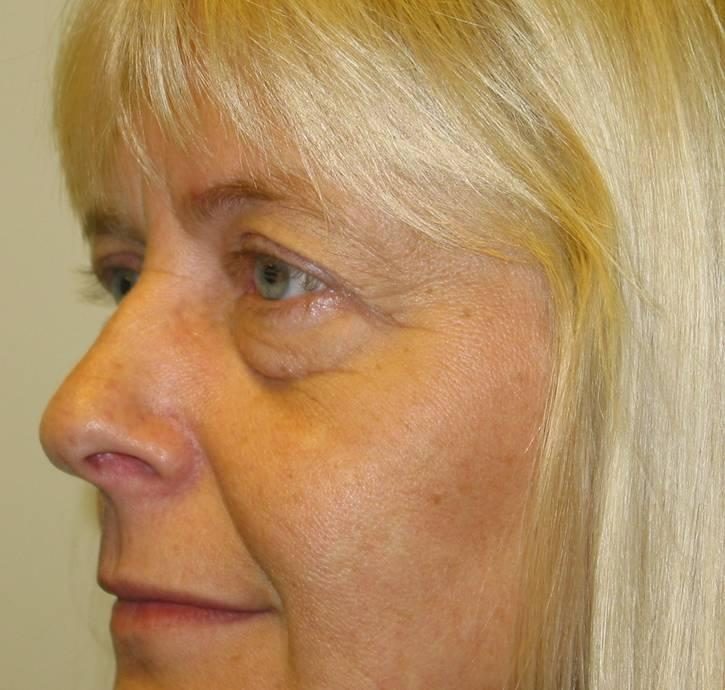 Eyelid Lift before