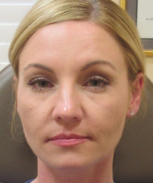 Rhinoplasty before