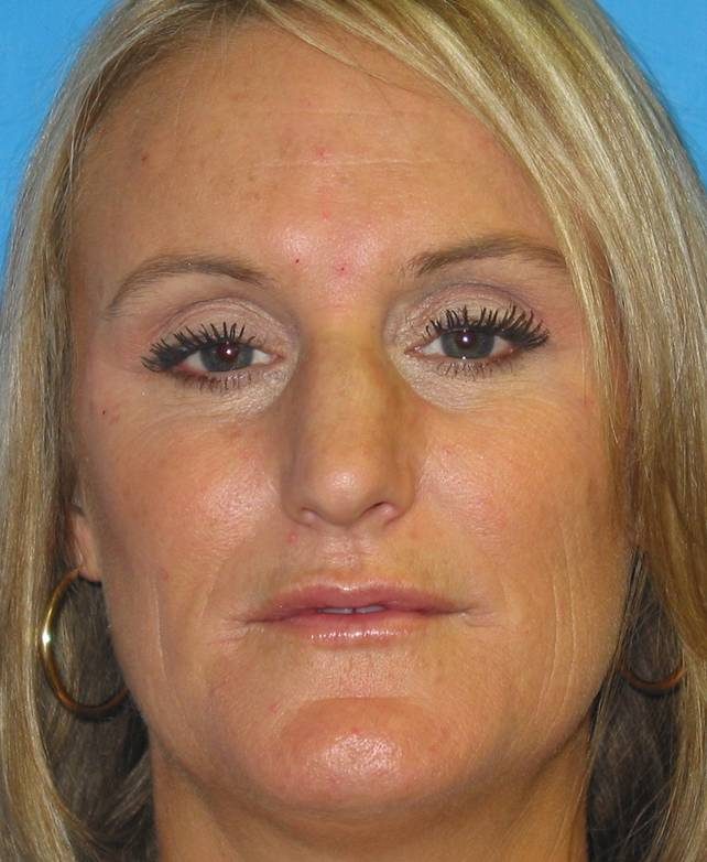 Rhinoplasty before