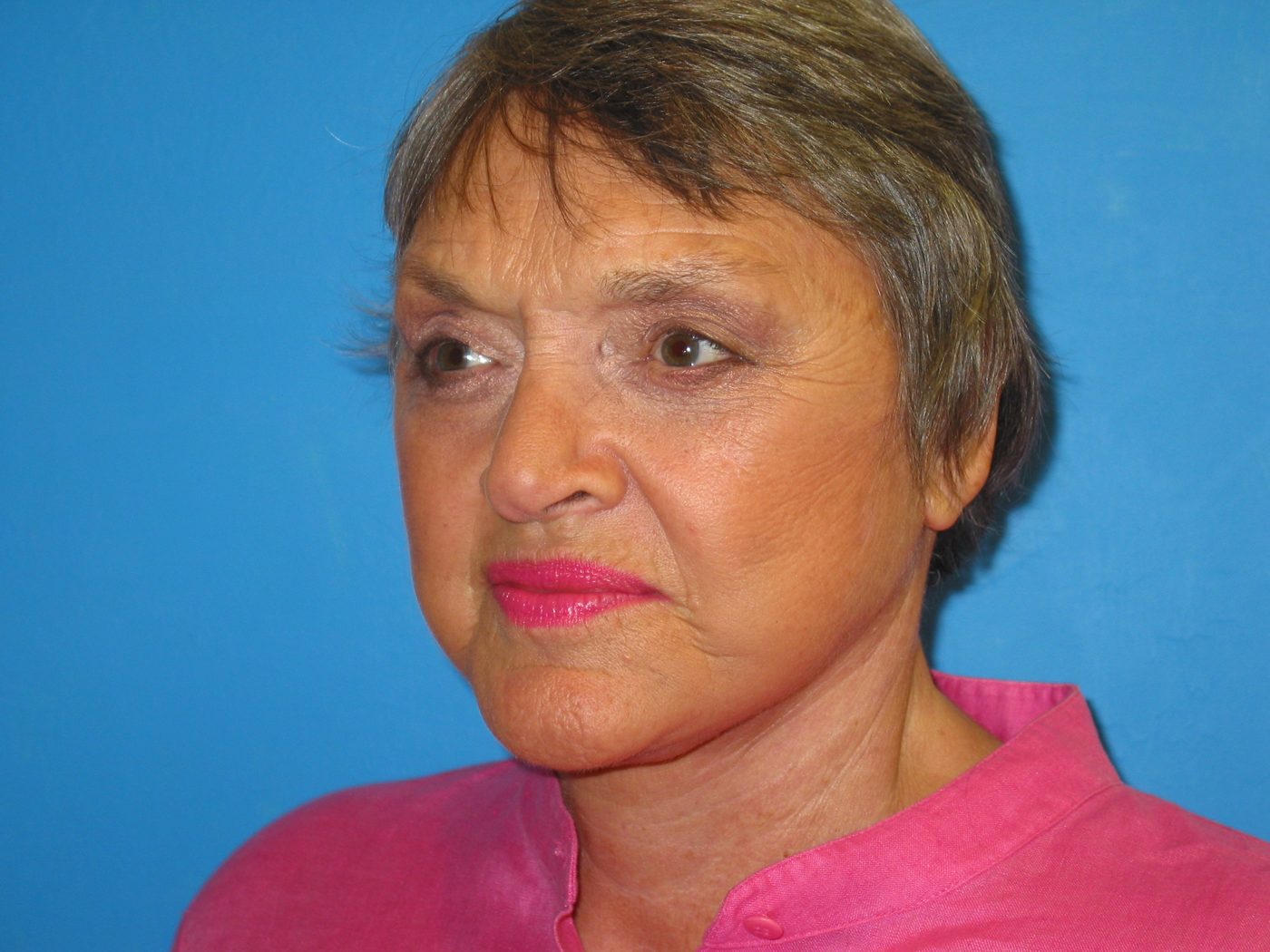Endoscopic Brow Lift after