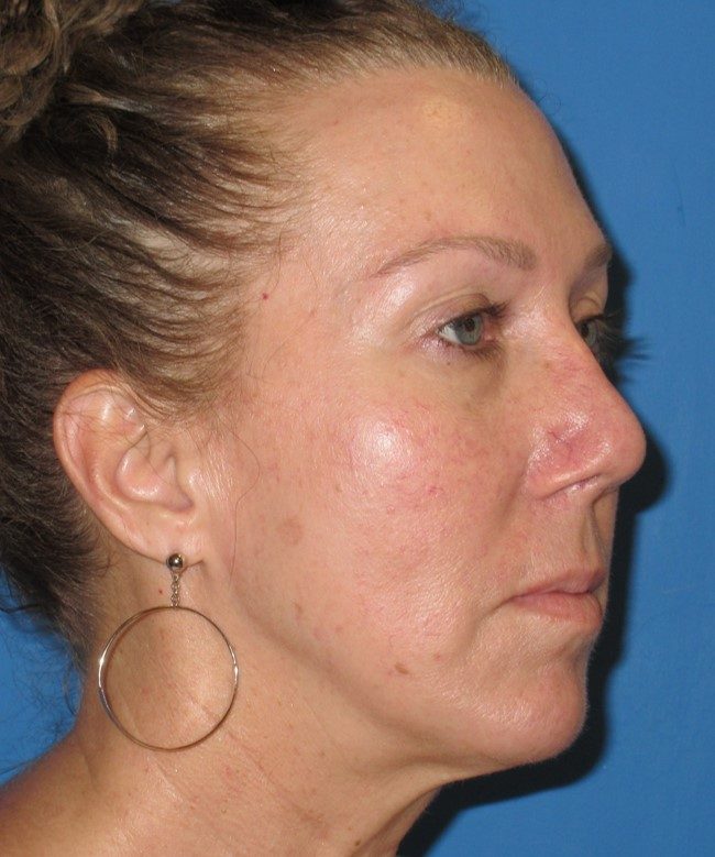 Rhinoplasty after