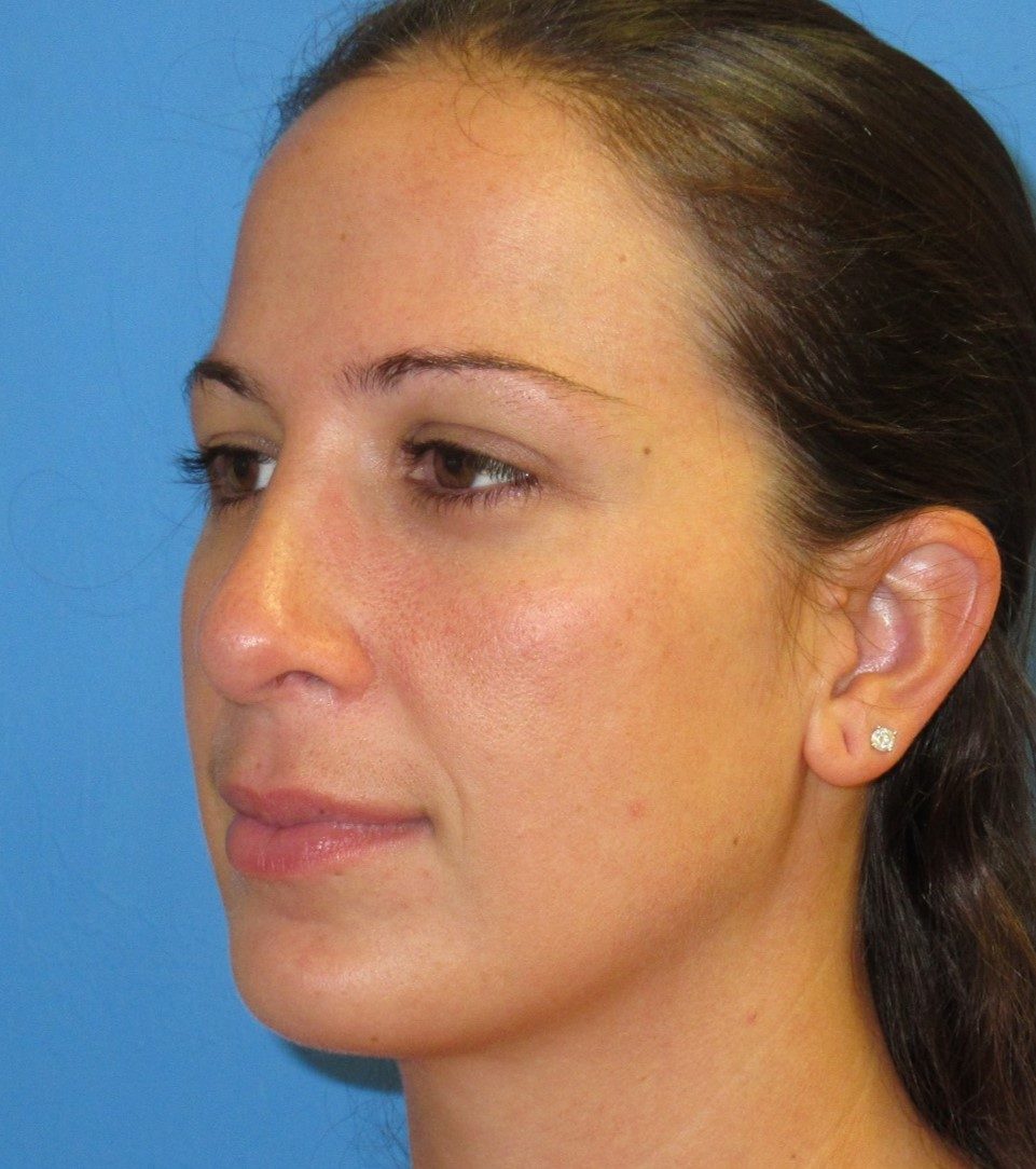 Rhinoplasty after