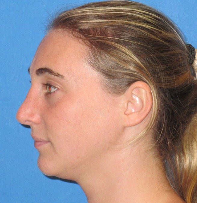 Rhinoplasty after