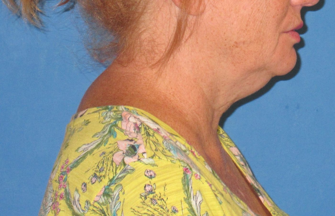 Deep Neck Contouring before