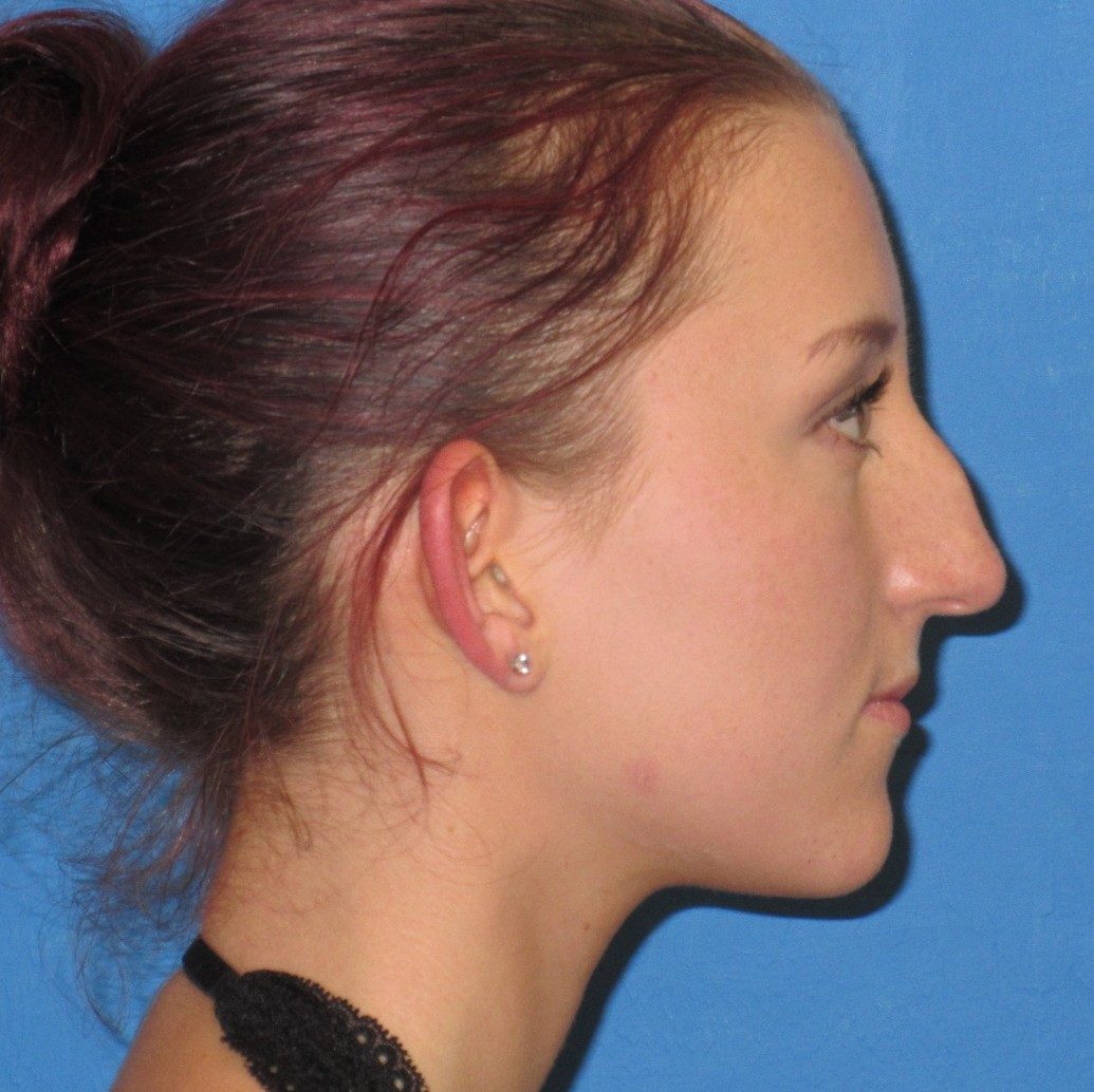 Rhinoplasty before