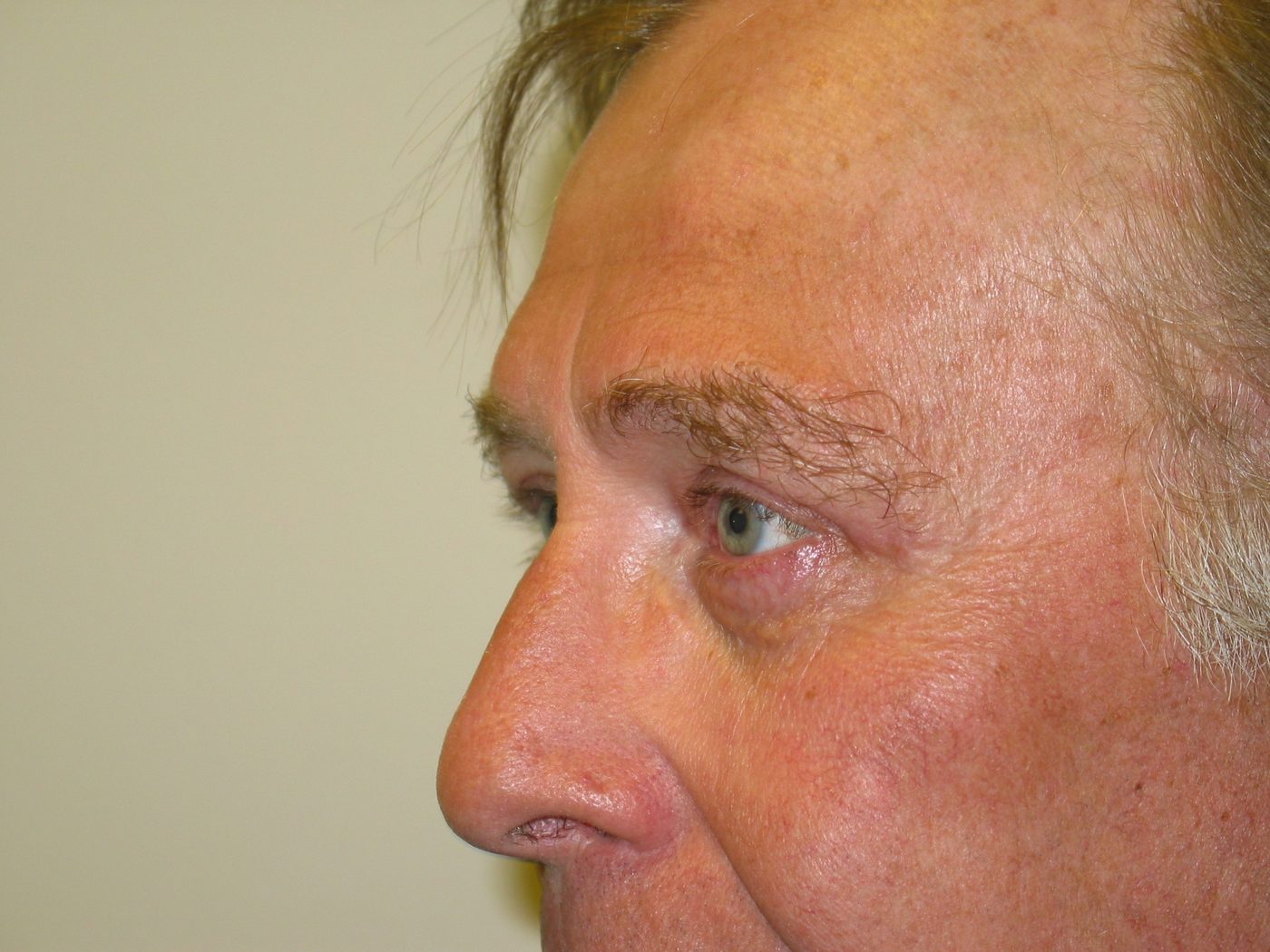 Eyelid Lift after
