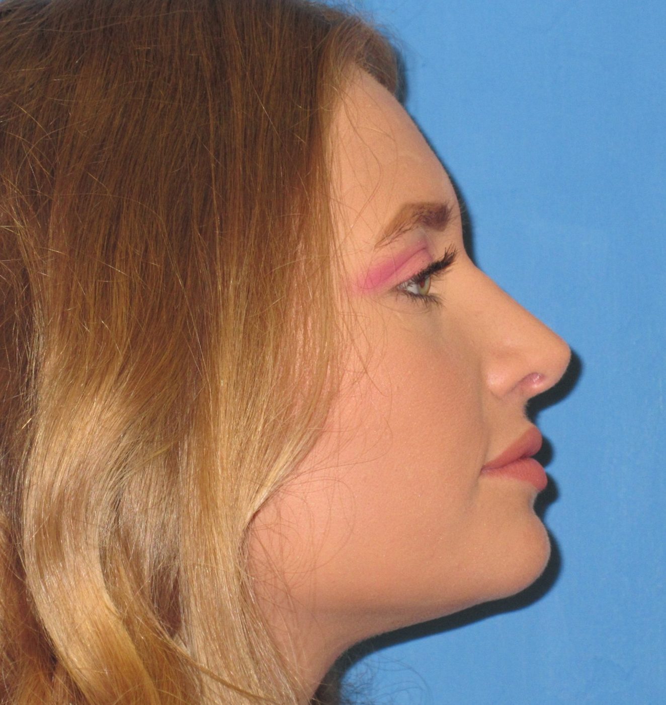 Rhinoplasty after