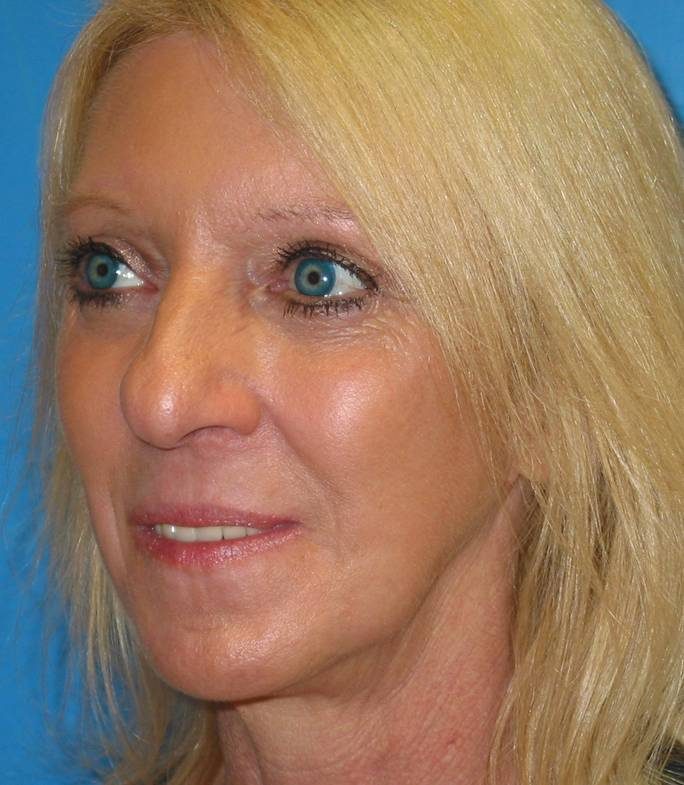 Endoscopic Brow Lift after