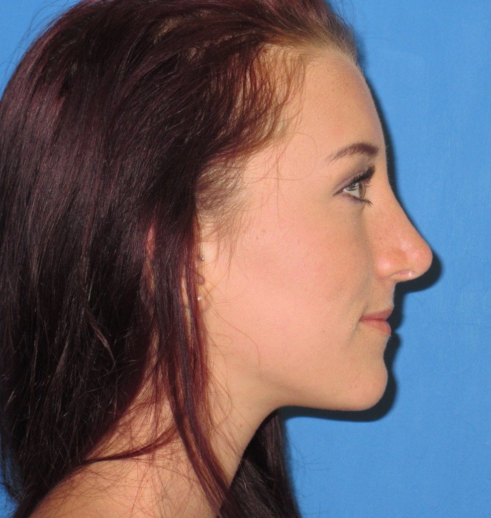 Rhinoplasty after