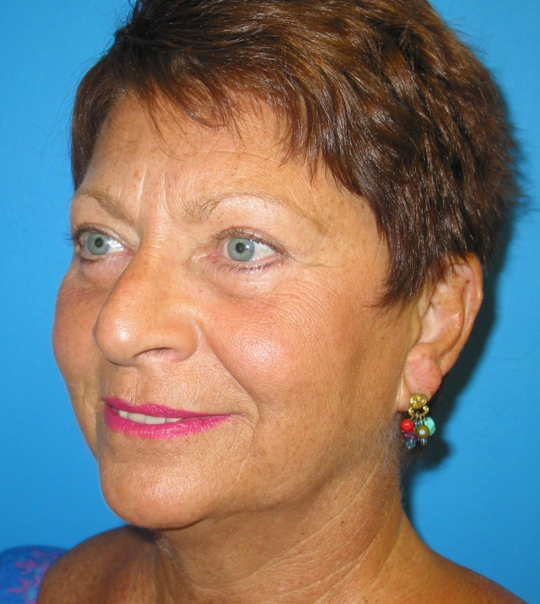 Eyelid Lift after
