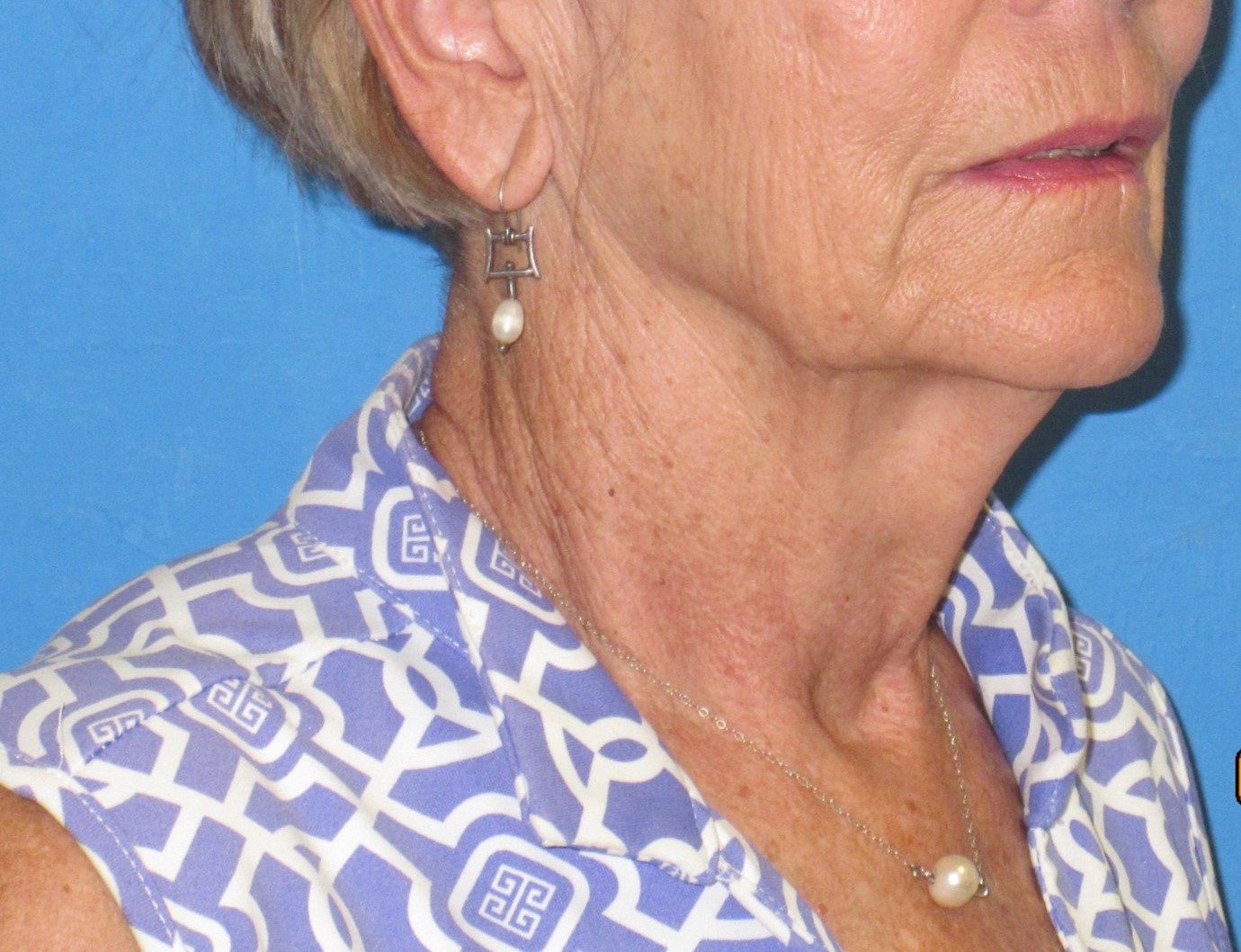 Deep Neck Contouring before
