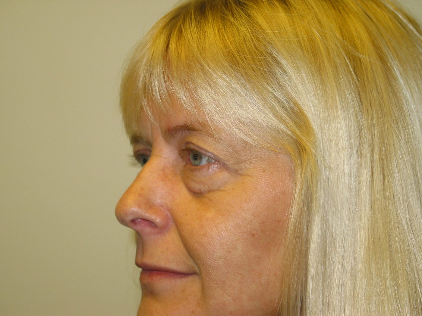 Endoscopic Brow Lift before